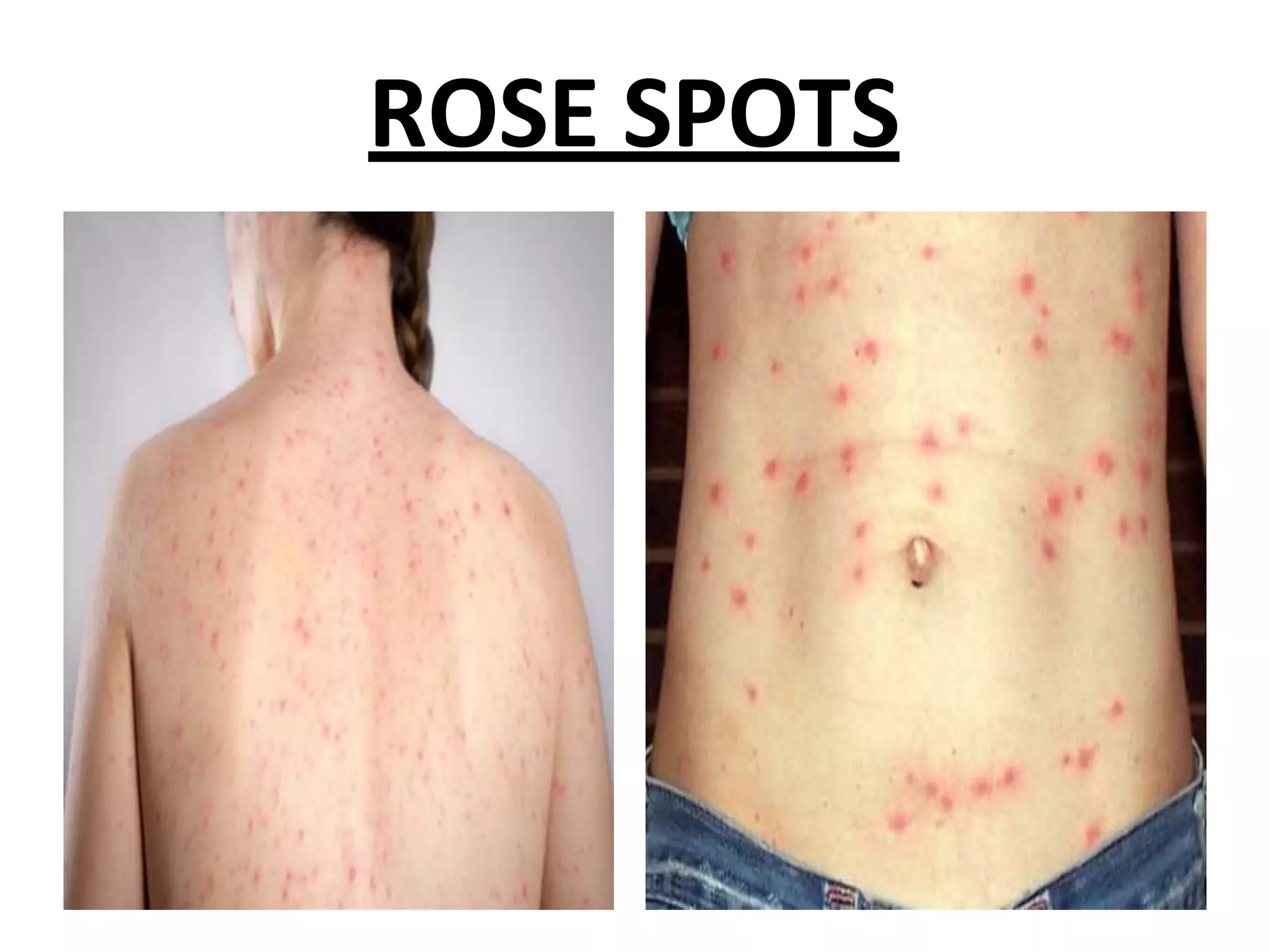 ROSE SPOTS
 