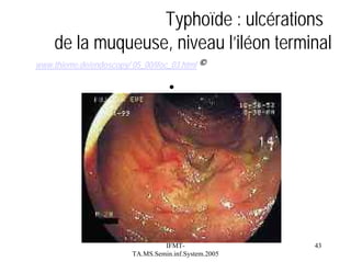 Typhoïde : ulcérations
de la muqueuse, niveau l’iléon terminal
www.thieme.de/endoscopy/ 05_00/ifoc_03.html ©

•

IFMTTA.MS.Semin.inf.System.2005

43

 