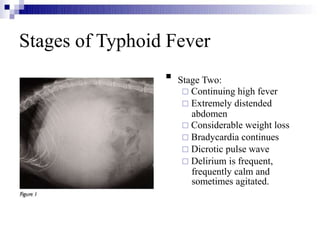 Stages of Typhoid Fever

Stage Two:
 Continuing high fever
 Extremely distended
abdomen
 Considerable weight loss
 Bradycardia continues
 Dicrotic pulse wave
 Delirium is frequent,
frequently calm and
sometimes agitated.
 