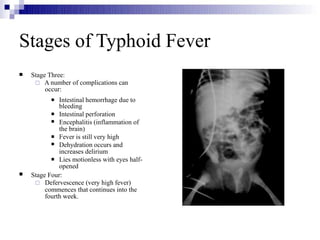 Stages of Typhoid Fever
 Stage Three:
 A number of complications can
occur:






Intestinal hemorrhage due to
bleeding
Intestinal perforation
Encephalitis (inflammation of
the brain)
Fever is still very high
Dehydration occurs and
increases delirium
Lies motionless with eyes half-
opened
 Stage Four:
 Defervescence (very high fever)
commences that continues into the
fourth week.
 