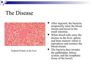 


After ingested, the bacteria
temporarily enter the blood
stream and travel to the
small intestine.
White blood cells carry the
disease to the liver, spleen
and bone marrow where it
reproduces and reenters the
blood stream.
The bacteria then invades
the gallbladder, biliary
system, and the lymphatic
tissue of the bowel.
The Disease
Typhoid Nodule in the liver
 