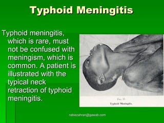 Typhoid Meningitis   Typhoid meningitis, which is rare, must not be confused with meningism, which is common. A patient is illustrated with the typical neck retraction of typhoid meningitis. [email_address] 