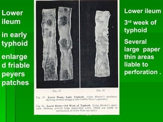 [email_address] Lower ileum  in early typhoid  enlarged friable peyers patches Lower ileum 3 rd  week of typhoid Several large  paper thin areas liable to perforation . 
