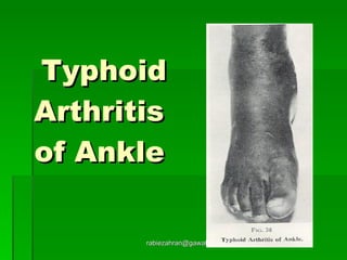 Typhoid Arthritis  of Ankle   [email_address] 