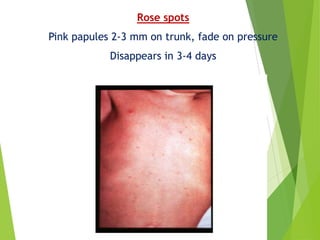 Rose spots
Pink papules 2-3 mm on trunk, fade on pressure
Disappears in 3-4 days
 