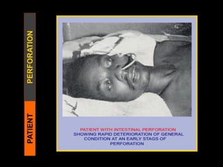 PATIENTPERFORATION
 