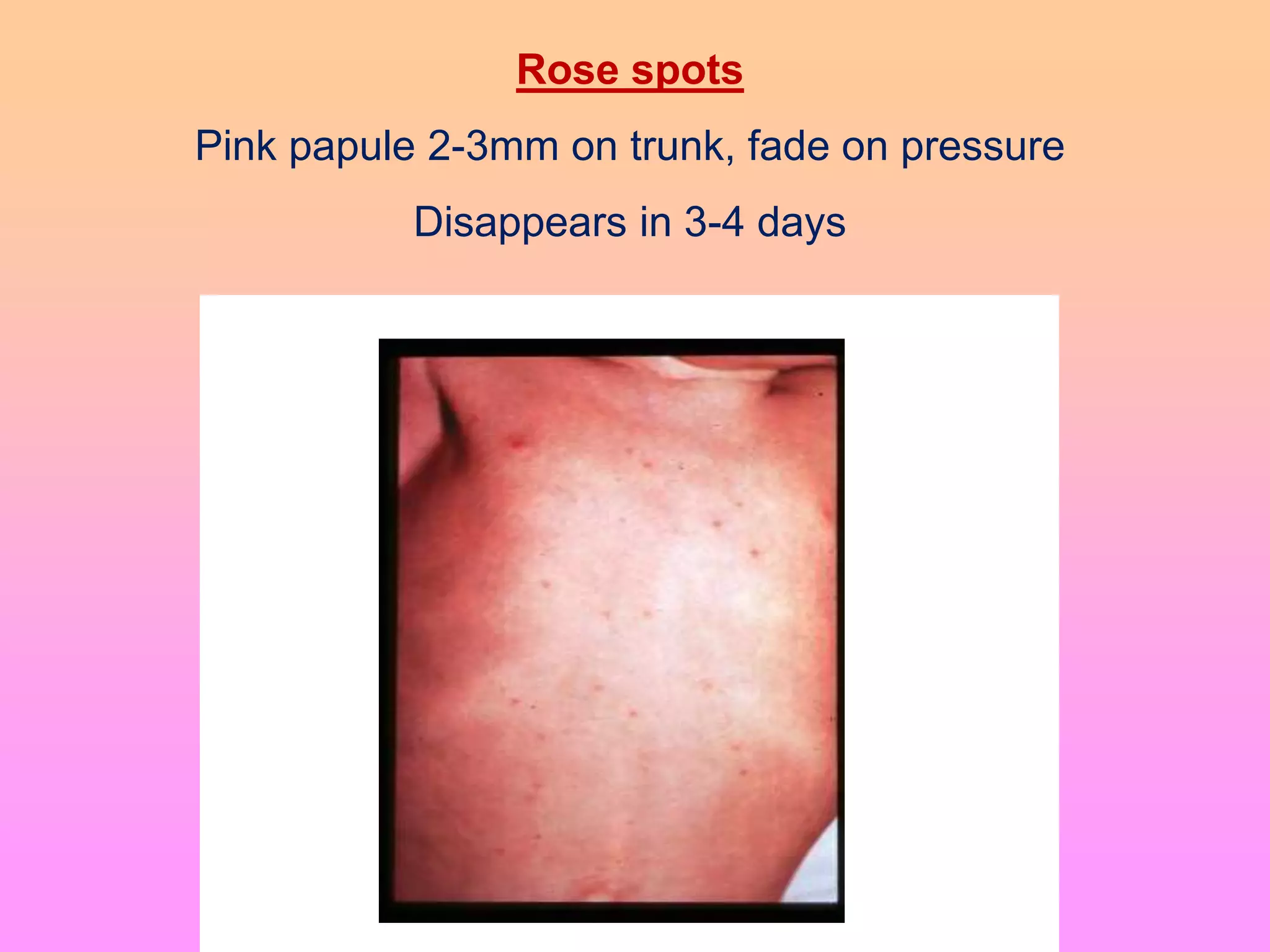 Rose spots
Pink papule 2-3mm on trunk, fade on pressure
Disappears in 3-4 days
 
