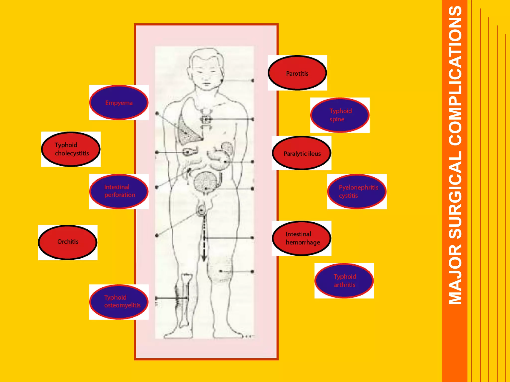 MAJORSURGICALCOMPLICATIONS
 