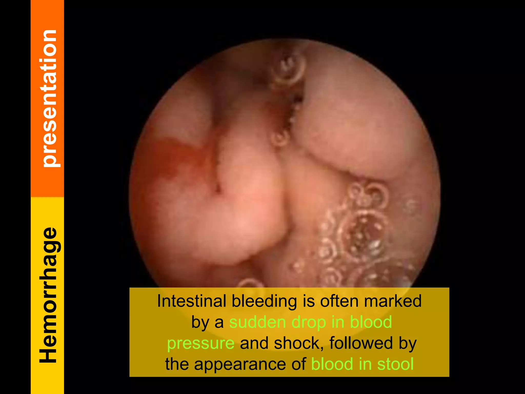 Intestinal bleeding is often marked
by a sudden drop in blood
pressure and shock, followed by
the appearance of blood in stool
Hemorrhagepresentation
 