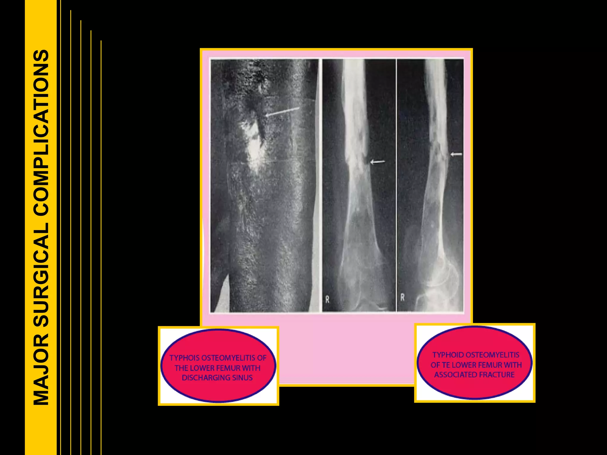 MAJORSURGICALCOMPLICATIONS
 