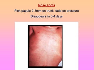 Rose spots
Pink papule 2-3mm on trunk, fade on pressure
Disappears in 3-4 days
 