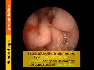 Intestinal bleeding is often marked
by a sudden drop in blood
pressure and shock, followed by
the appearance of blood in stool
Hemorrhagepresentation
 