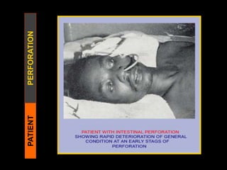 PATIENTPERFORATION
 