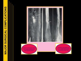 MAJORSURGICALCOMPLICATIONS
 