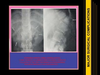 MAJORSURGICALCOMPLICATIONS
 