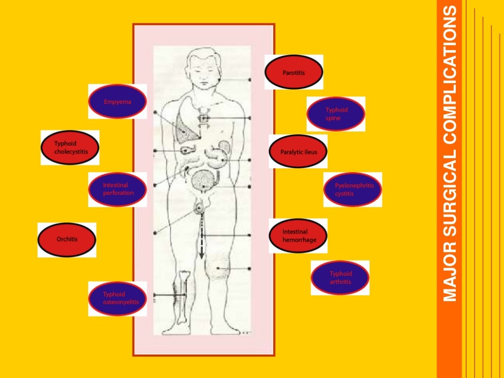 Typhoid fever ppt Typhoid fever ppt