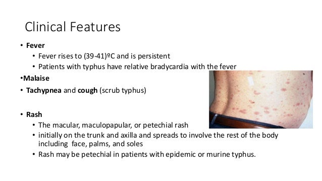 typhus fever