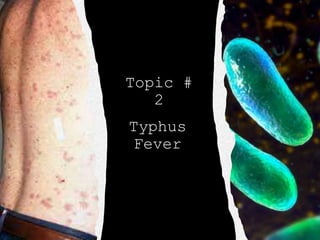 Topic #
2
Typhus
Fever
 