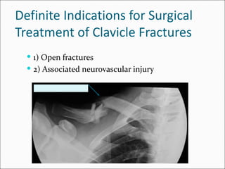 Definite Indications for Surgical
Treatment of Clavicle Fractures
   1) Open fractures
   2) Associated neurovascular injury
 