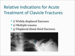 Relative Indications for Acute
Treatment of Clavicle Fractures
    1) Widely displaced fractures
    2) Multiple trauma
    3) Displaced distal-third fractures
 