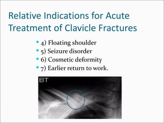 Relative Indications for Acute
Treatment of Clavicle Fractures
       4) Floating shoulder
       5) Seizure disorder
       6) Cosmetic deformity
       7) Earlier return to work.
 