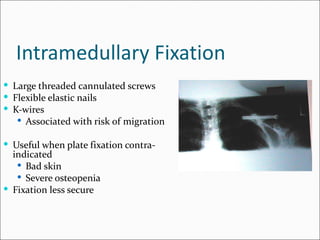 Intramedullary Fixation
 Large threaded cannulated screws
 Flexible elastic nails
 K-wires
    Associated with risk of migration

 Useful when plate fixation contra-
  indicated
    Bad skin
    Severe osteopenia
 Fixation less secure
 