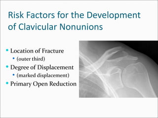Risk Factors for the Development
of Clavicular Nonunions

 Location of Fracture
   (outer third)
 Degree of Displacement
   (marked displacement)
 Primary Open Reduction
 