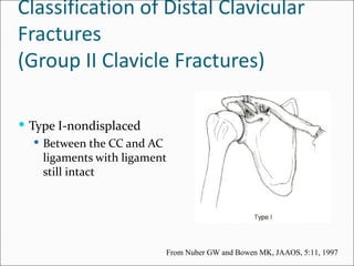 Classification of Distal Clavicular
Fractures
(Group II Clavicle Fractures)

 Type I-nondisplaced
    Between the CC and AC
     ligaments with ligament
     still intact




                           From Nuber GW and Bowen MK, JAAOS, 5:11, 1997
 