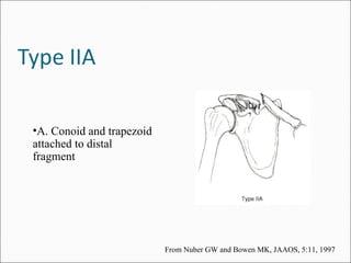 •A. Conoid and trapezoid
attached to distal
fragment




                           From Nuber GW and Bowen MK, JAAOS, 5:11, 1997
 