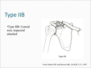 •Type IIB: Conoid
torn, trapezoid
attached




                    From Nuber GW and Bowen MK, JAAOS, 5:11, 1997
 
