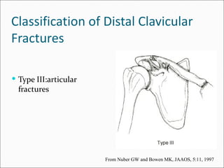 Classification of Distal Clavicular
Fractures

 Type III:articular
  fractures




                       From Nuber GW and Bowen MK, JAAOS, 5:11, 1997
 