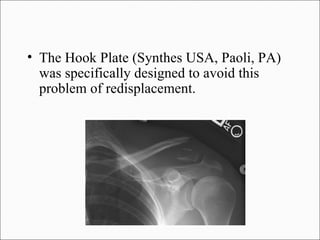 • The Hook Plate (Synthes USA, Paoli, PA)
  was specifically designed to avoid this
  problem of redisplacement.
 
