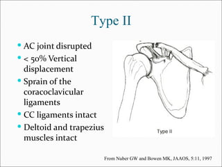 Type II
 AC joint disrupted
 < 50% Vertical
  displacement
 Sprain of the
  coracoclavicular
  ligaments
 CC ligaments intact
 Deltoid and trapezius
  muscles intact

                          From Nuber GW and Bowen MK, JAAOS, 5:11, 1997
 