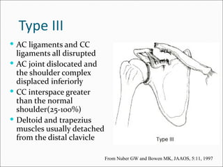 Type III
 AC ligaments and CC
  ligaments all disrupted
 AC joint dislocated and
  the shoulder complex
  displaced inferiorly
 CC interspace greater
  than the normal
  shoulder(25-100%)
 Deltoid and trapezius
  muscles usually detached
  from the distal clavicle

                             From Nuber GW and Bowen MK, JAAOS, 5:11, 1997
 