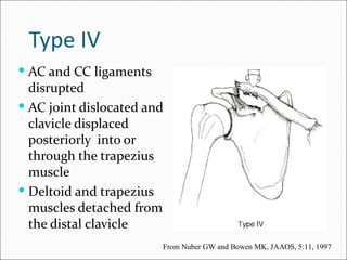 Type IV
 AC and CC ligaments
  disrupted
 AC joint dislocated and
  clavicle displaced
  posteriorly into or
  through the trapezius
  muscle
 Deltoid and trapezius
  muscles detached from
  the distal clavicle
                        From Nuber GW and Bowen MK, JAAOS, 5:11, 1997
 