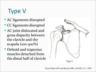 Type V
 AC ligaments disrupted
 CC ligaments disrupted
 AC joint dislocated and
  gross disparity between
  the clavicle and the
  scapula (100-300%)
 Deltoid and trapezius
  muscles detached from
  the distal half of clavicle

                            From Nuber GW and Bowen MK, JAAOS, 5:11, 1997
 