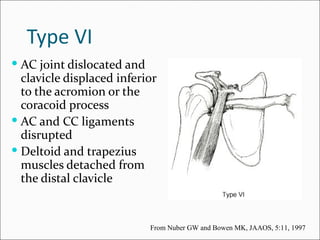 Type VI
 AC joint dislocated and
  clavicle displaced inferior
  to the acromion or the
  coracoid process
 AC and CC ligaments
  disrupted
 Deltoid and trapezius
  muscles detached from
  the distal clavicle


                            From Nuber GW and Bowen MK, JAAOS, 5:11, 1997
 