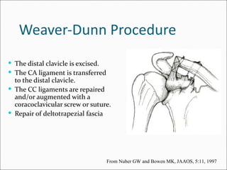Weaver-Dunn Procedure
 The distal clavicle is excised.
 The CA ligament is transferred
  to the distal clavicle.
 The CC ligaments are repaired
  and/or augmented with a
  coracoclavicular screw or suture.
 Repair of deltotrapezial fascia




                                    From Nuber GW and Bowen MK, JAAOS, 5:11, 1997
 