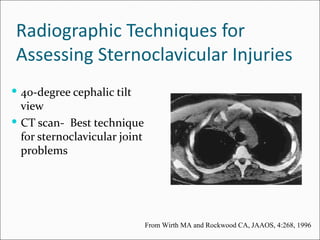 Radiographic Techniques for
 Assessing Sternoclavicular Injuries
 40-degree cephalic tilt
  view
 CT scan- Best technique
  for sternoclavicular joint
  problems




                               From Wirth MA and Rockwood CA, JAAOS, 4:268, 1996
 