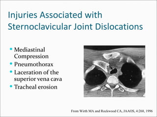 Injuries Associated with
Sternoclavicular Joint Dislocations

 Mediastinal
  Compression
 Pneumothorax
 Laceration of the
  superior vena cava
 Tracheal erosion



                       From Wirth MA and Rockwood CA, JAAOS, 4:268, 1996
 