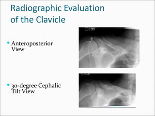Radiographic Evaluation
 of the Clavicle

 Anteroposterior
 View




 30-degree Cephalic
 Tilt View
 