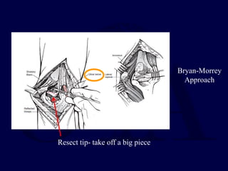 2-distal-humerus-fractures-in-eldarly-pt-pdf