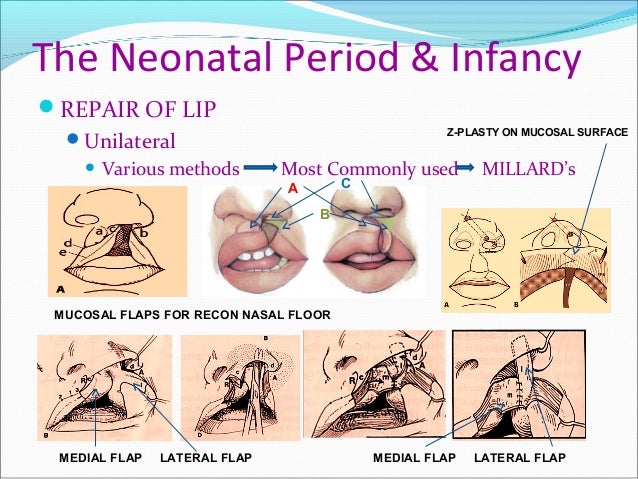 clinical-aspects-of-cleft-lip-and-palate-reconstruction-2-rec-7-638.jpg?cb=1417776954