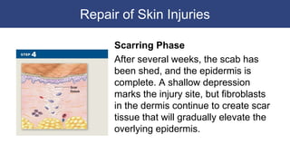 Repair of Skin Injuries
Scarring Phase
After several weeks, the scab has
been shed, and the epidermis is
complete. A shallow depression
marks the injury site, but fibroblasts
in the dermis continue to create scar
tissue that will gradually elevate the
overlying epidermis.
 
