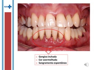 o Gengiva inchada
o Cor avermelhada
o Sangramento espontâneo
 