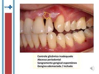 o Controle glicêmico inadequado
o Abcesso periodontal
o Sangramento gengival espontâneo
o Gengiva edemaciada / inchada
 