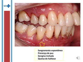 o Sangramento espontâneo
o Presença de pus
o Gengiva inchada
o Queixa de halitose
 