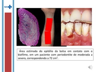 Área estimada do epitélio da bolsa em contato com o
biofilme, em um paciente com periodontite de moderada a
severa, correspondendo a 72 cm2.
 