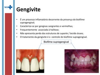 Gengivite
• É um processo inflamatório decorrente da presença do biofilme
supragengival;
• Caracteriza-se por gengivas sangrantes e vermelhas;
• Frequentemente associada à halitose;
• Não apresenta perda das estruturas de suporte / tecido ósseo;
• O tratamento da gengivite é o controle do biofilme supragengival.
Biofilme supragengival
 