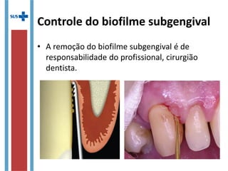 Controle do biofilme subgengival
• A remoção do biofilme subgengival é de
responsabilidade do profissional, cirurgião
dentista.
 